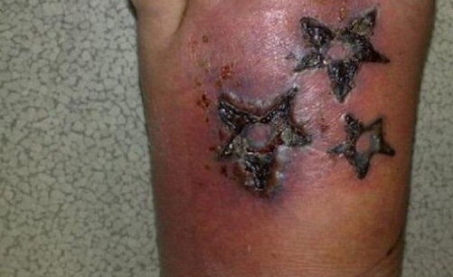HA PAGATO 25 EURO PER UN TATUAGGIO: ORA RISCHIA L'AMPUTAZIONE DEL PIEDE - 06/09/2016
