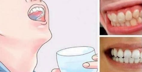 SCIACQUA LA BOCCA CON QUESTO MIX PER 30 SECONDI: PLACCA E TARTARO ANDRANNO VIA ALL'ISTANTE - 09/01/2017