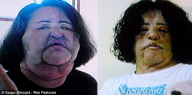 OSSESSIONATA DALLA CHIRURGIA: SI INIETTA OLIO DA CUCINA IN FACCIA E RESTA SFIGURATA - VIDEO - 08/05/2013