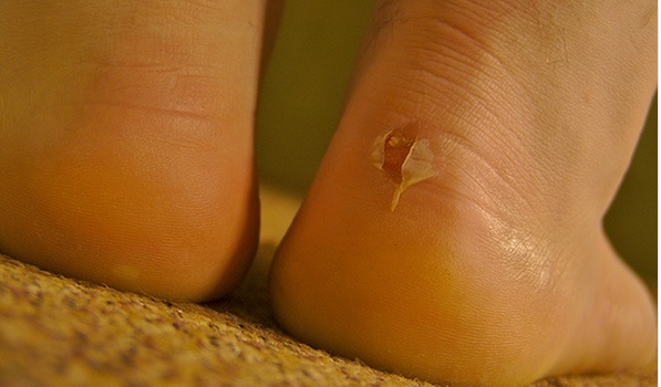 SCARPE SCOMODE? ECCO COME FAR SPARIRE SUBITO LESIONI E BOLLE SUI PIEDI - 21/09/2015