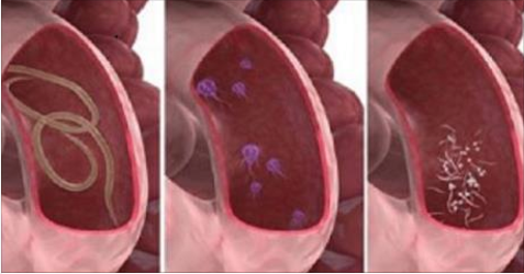 SE HAI QUESTI COMUNI SINTOMI POTRESTI AVERE L'INTESTINO PIENO DI PARASSITI - 03/04/2017