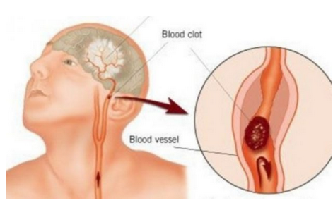 IN CASO DI ICTUS CI SONO SOLO 60 MINUTI DI TEMPO PER SALVARSI: ECCO COSA BISOGNA FARE - 05/06/2017