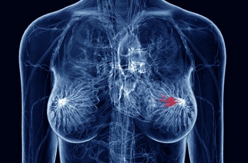 CANCRO, COME RICONOSCERE I SINTOMI PIU' DIFFUSI - 09/12/2013