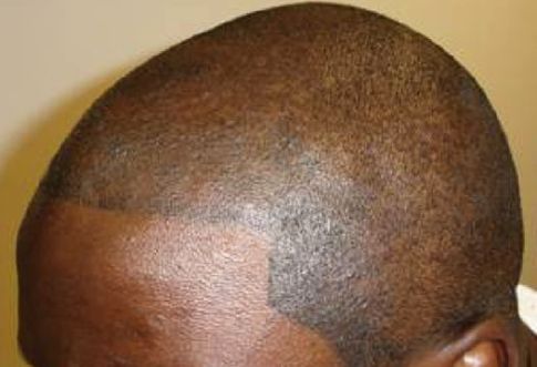 I CAPELLI TATUATI: ECCO LA NUOVA MODA CONTRO LA CALVIZIA - 22/07/2014