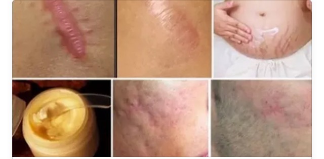 ELIMINARE LE CICATRICI DA QUALSIASI PARTE DEL CORPO IN MENO DI UN MESE: ECCO COME - 03/07/2016