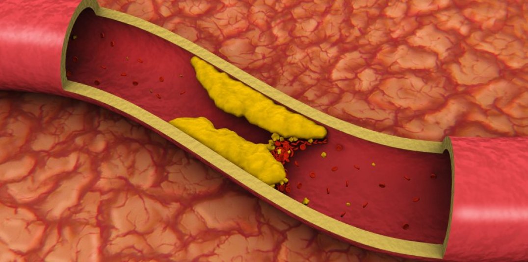 L'ALIMENTO CHE PULISCE LE VENE E ARTERIE CONTRASTANDO L'INFARTO IN 6 MINUTI - 26/07/2016