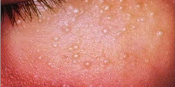 PALLINI MINUSCOLI SUL VISO: ECCO DI COSA SI TRATTA E COME CURARLI - 19/02/2016